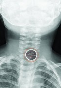Engasgar ao comer carne ou outros alimentos pode levar à morte. Saiba como evitar